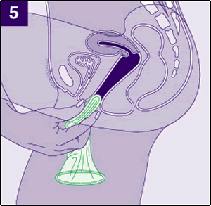 5. Осторожно введите внутреннее кольцо презерватива во влагалище и вставьте его.