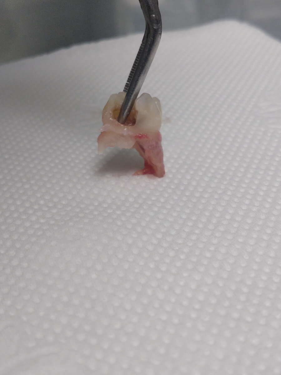 На фото зуб у которого рассосался только один корень. 