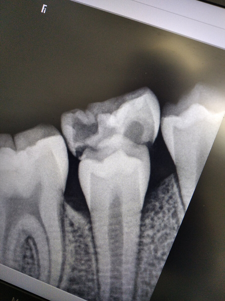 На фото постоянный 5 зуб (второй премоляр) под молочным зубом
