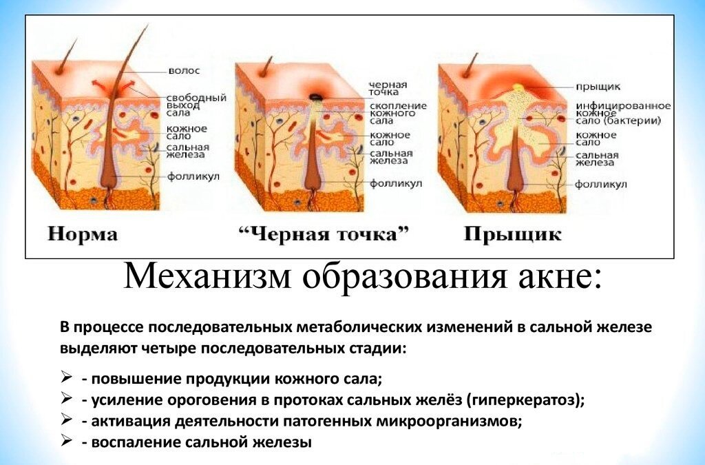 Акне угревая сыпь фото