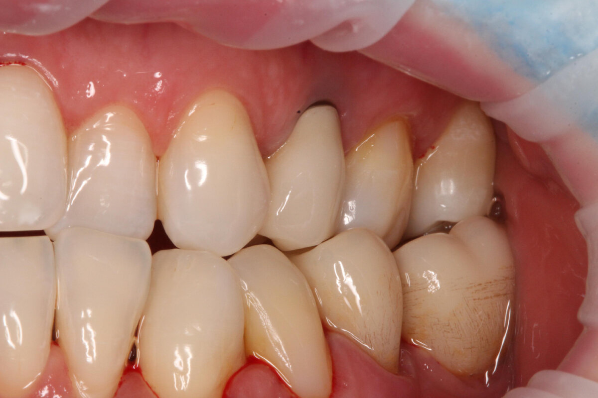 Как убрать щель между зубами?