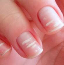 Как выглядит на руках эта болезнь ногтей, показано на фото. 