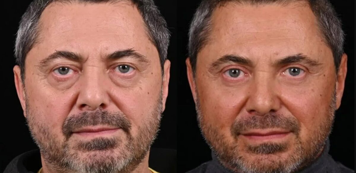 Проведена верхняя блефаропластика с иссечением кожи и удалением грыж и липофилинг средней зоны лица включая нижние веки. Фото до и после. Фото с сайта хирурга Д.Р. Гришкяна. Имеются противопоказания, требуется консультация специалиста