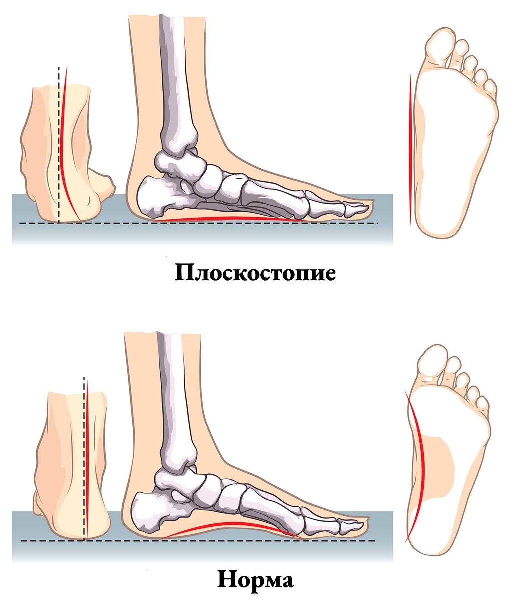 Плоскостопие