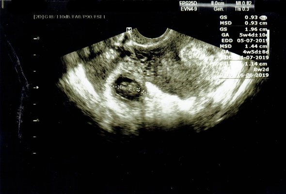    Внематочная беременность на УЗИ. Фото: ThoyibAs / Shutterstock / Fotodom