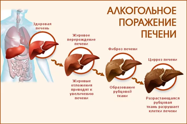 Алкоголь и печень картинки