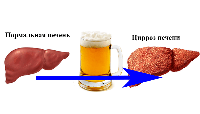 Алкоголь и печень картинки