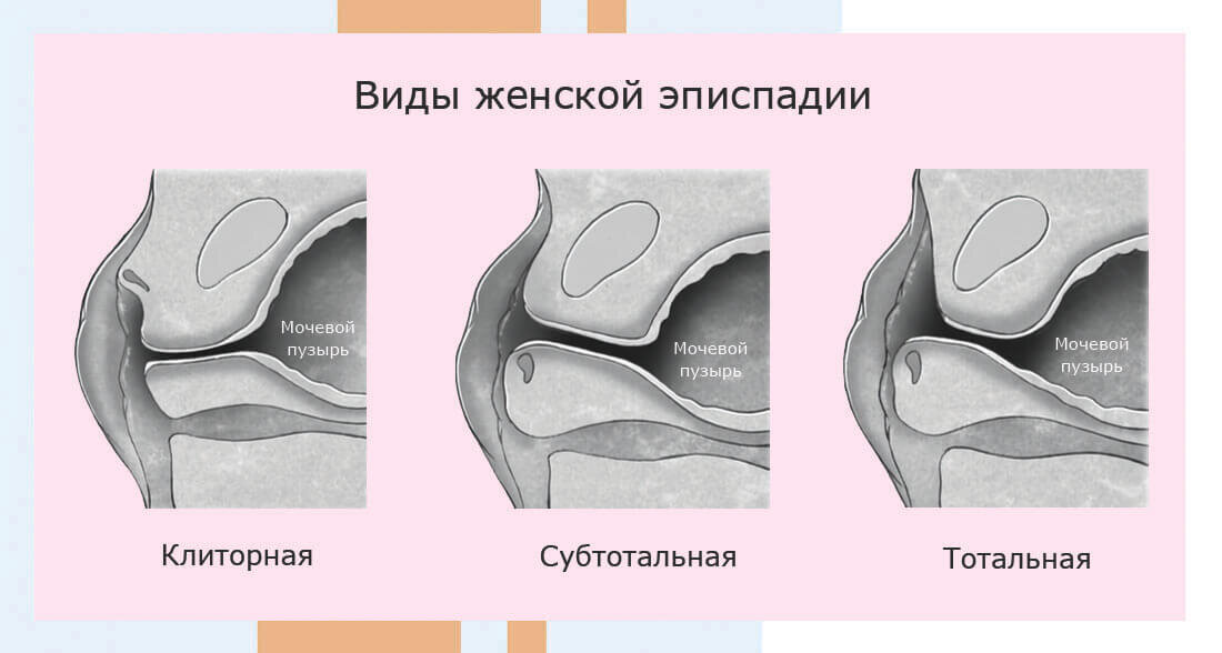 Пороки развития половых органов у детей