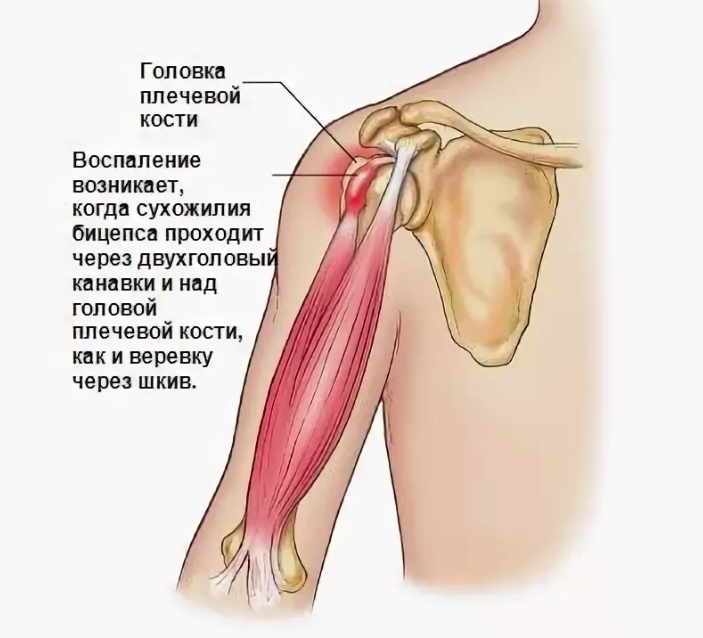 Тендинит надостной мышцы плечевого