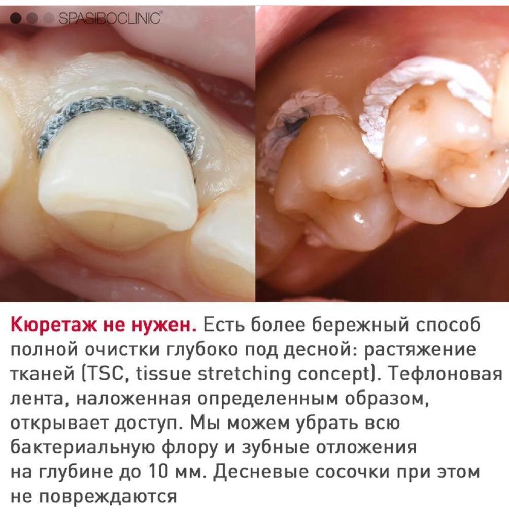 БЕЗ КЮРЕТАЖА | Спасибо.Клиник | Дзен