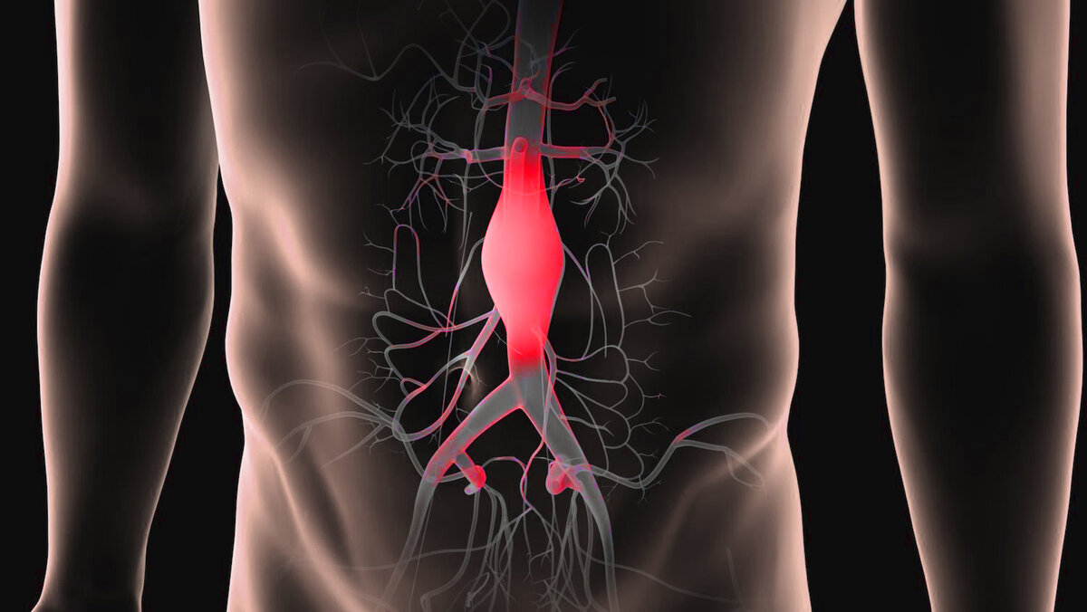 Схематичное изображение аневризмы брюшной аорты