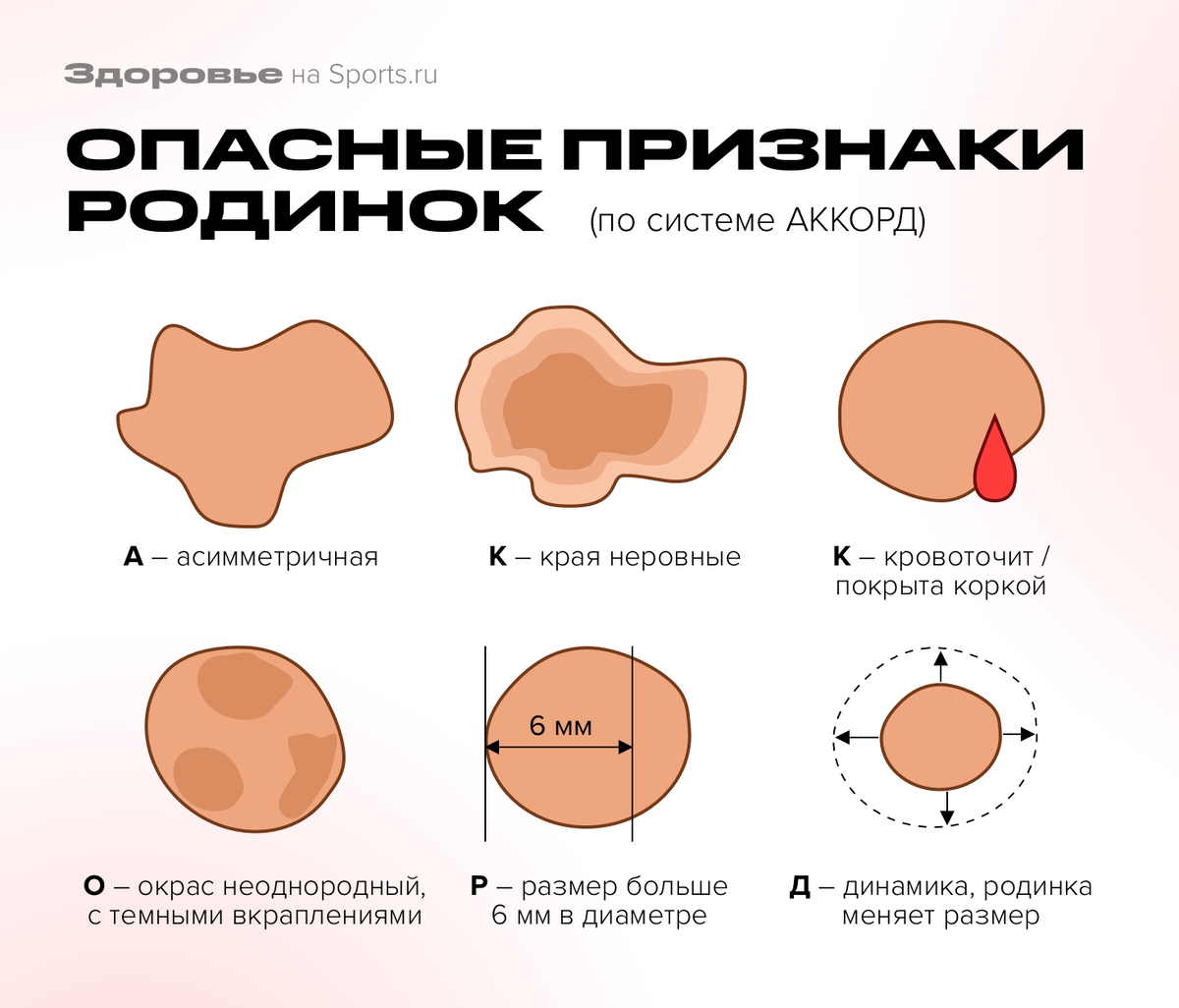 Родинки опасные как выглядят на теле человека Почему на самом деле появляются родинки? Как понять, какие из них опасны? Sports