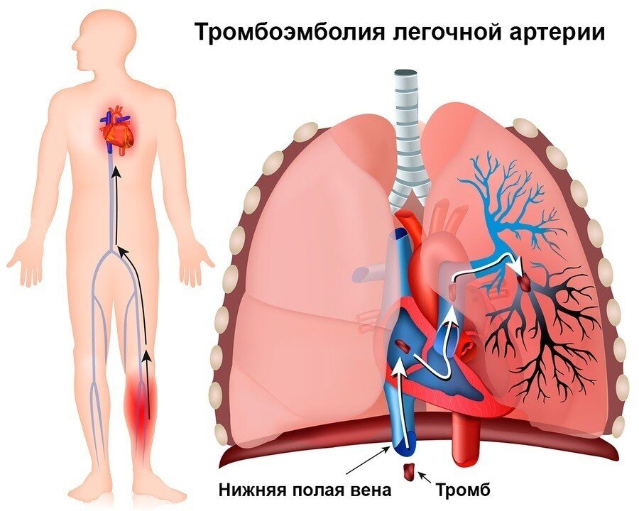 Причины тромбоза глубоких вен нижних конечностей