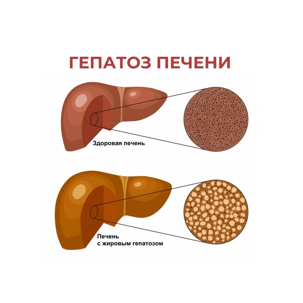 Жировой гепатоз в пожилом возрасте | Пансионаты "Теплые Беседы" | Дзен