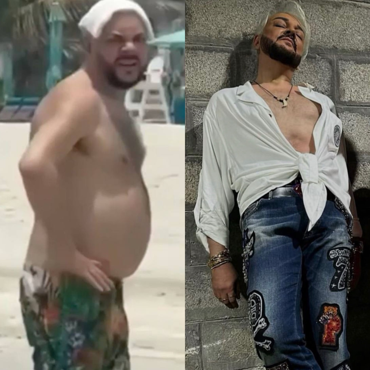 Киркоров до и после пластики