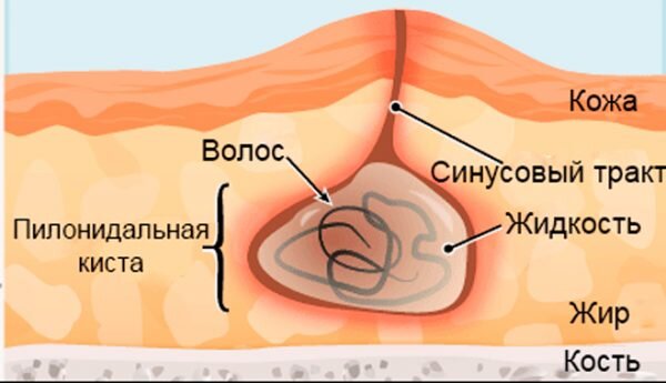 Лечение копчиковой кисты