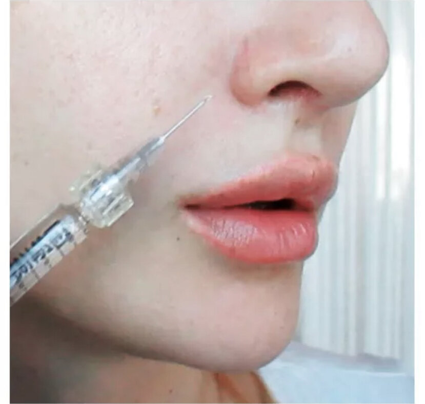 Введение филлеров в носогубные складки. Aesthefill филлер. Как правильно колоть филлеры. Контурная пластика губ филлерами. Как правильно колоть филлеры.