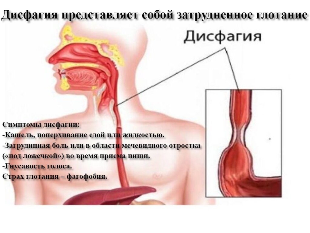 Дисфагия пищевода симптомы. Дисфагия исследование. Механическая дисфагия.