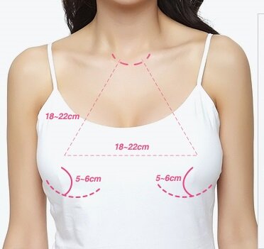 Разметка перед маммопластикой