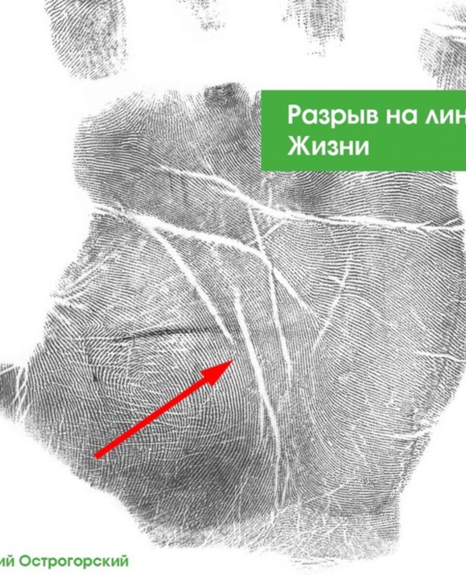 Огромный разрыв. Линия жизни разрывается. Внешний разрыв линии жизни. Хиромантия линия жизни с разрывом.