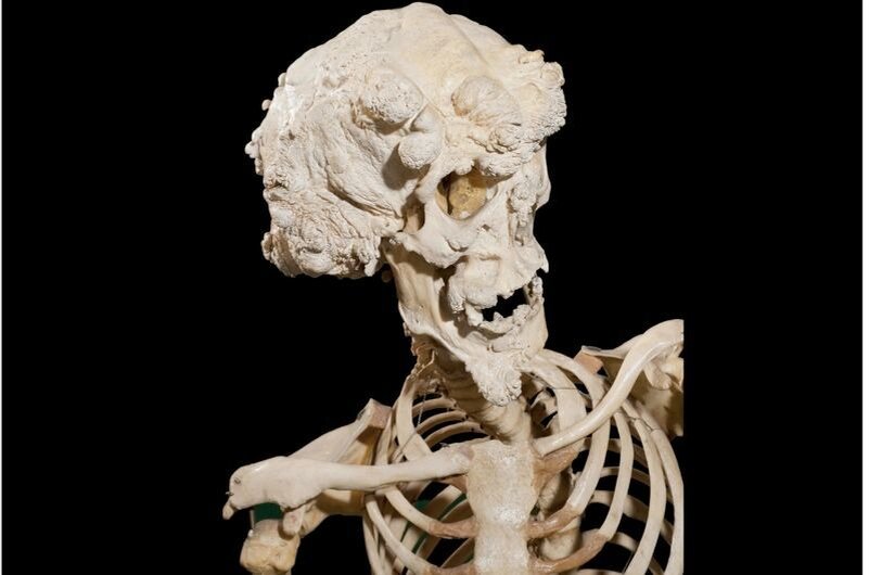 Синдром каменного человека. Оссифицирующая прогрессивная фибродисплазия. Фопа фото. Фибродисплазия скелет. Оссифицирующая фибродисплазия.