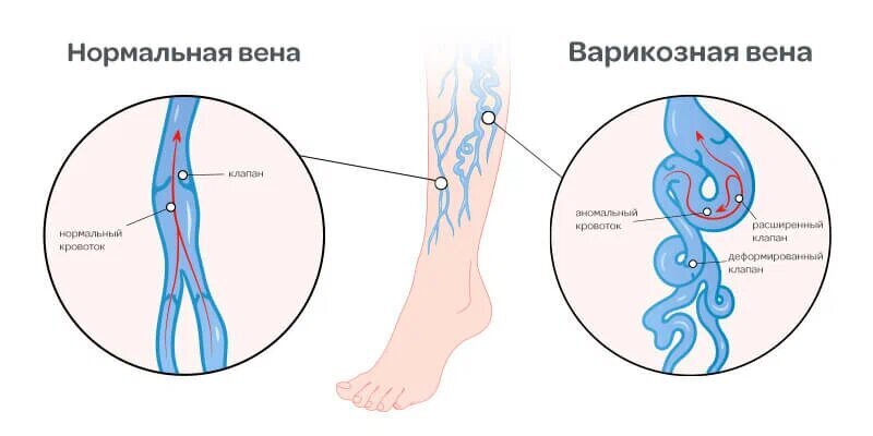 Болезни вен и беременность презентация