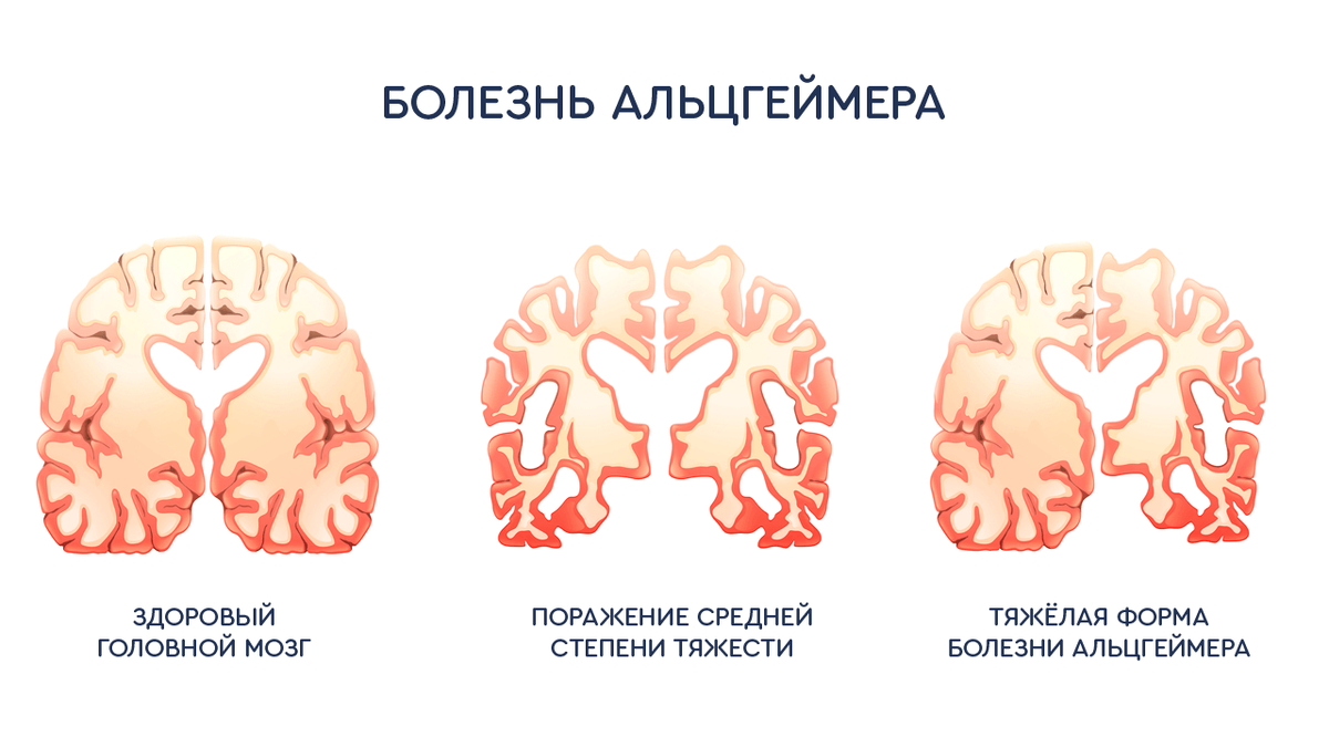 Изменение мозга. Болезнь Альцгеймера.