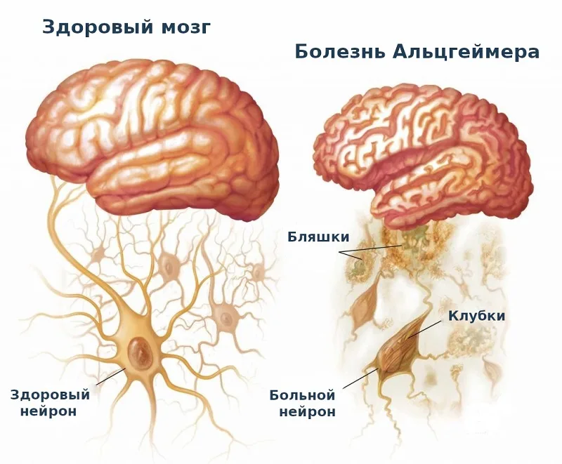 Болезнь альцгеймера клиническая картина