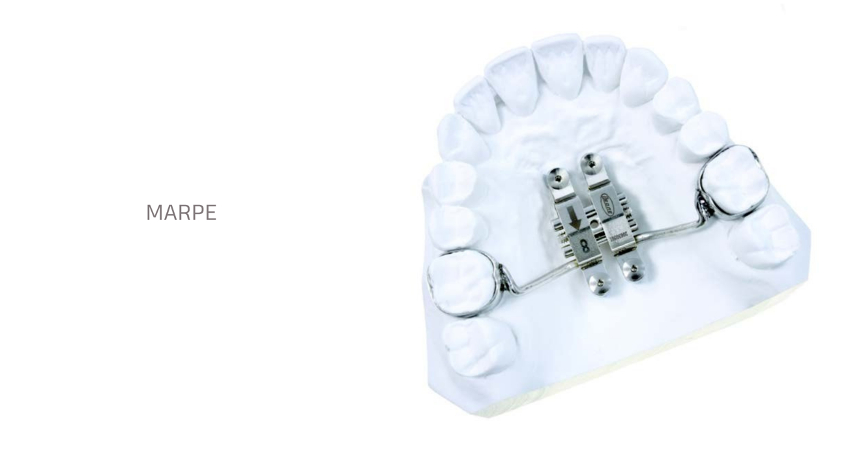 Аппарат MARPE (Minisrew-Assisted Rapid Palatal Expansion)