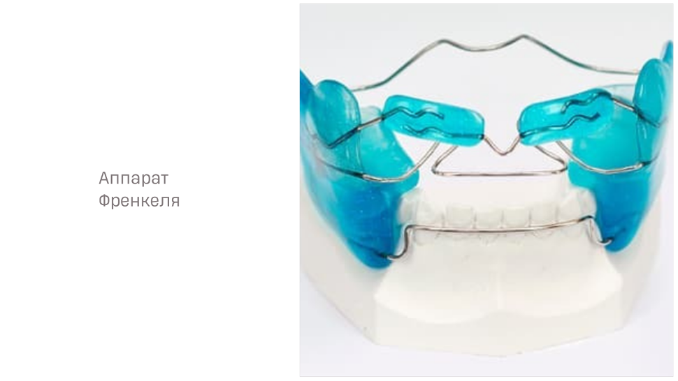 Аппарат Френкеля в ортодонтии: типы, фото — ROOTT