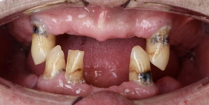на верхней челюсти осталось 2 клыка, на нижней 2 клыка и 1 резец.