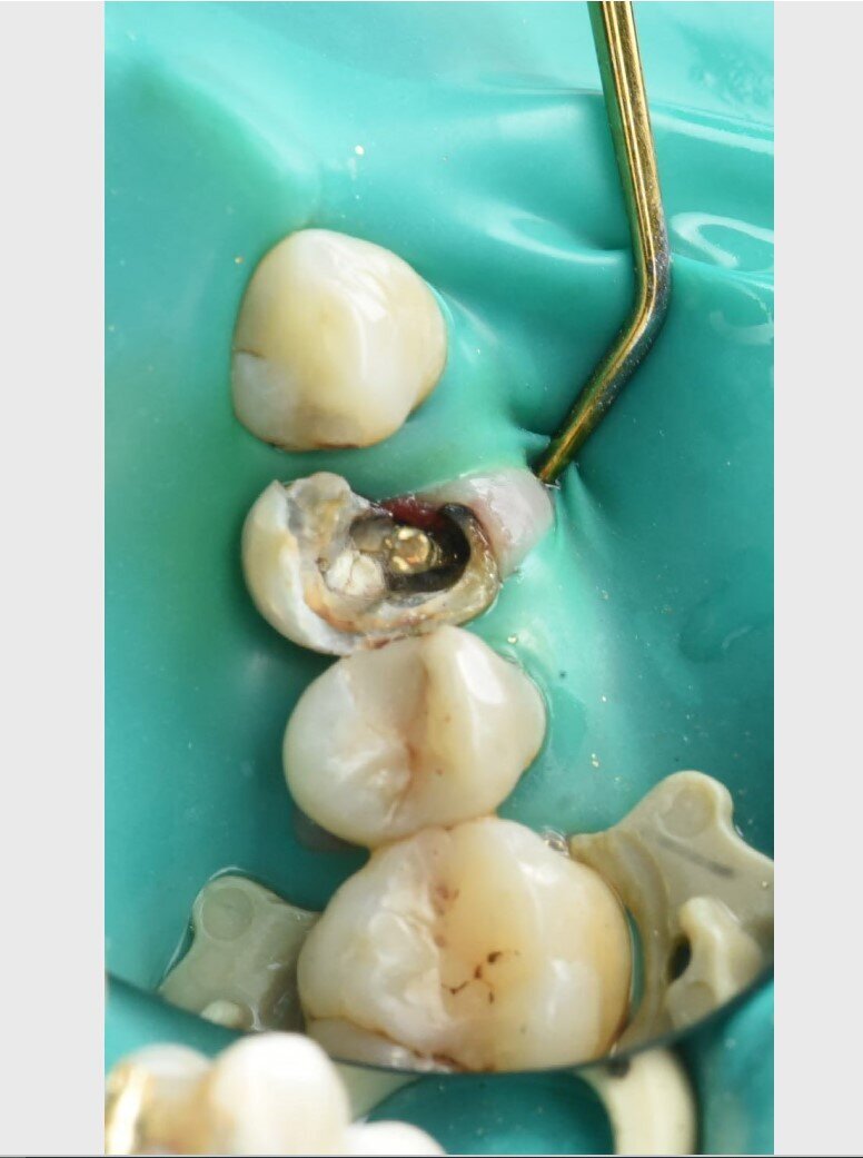 Зуб разрушен более 2/3