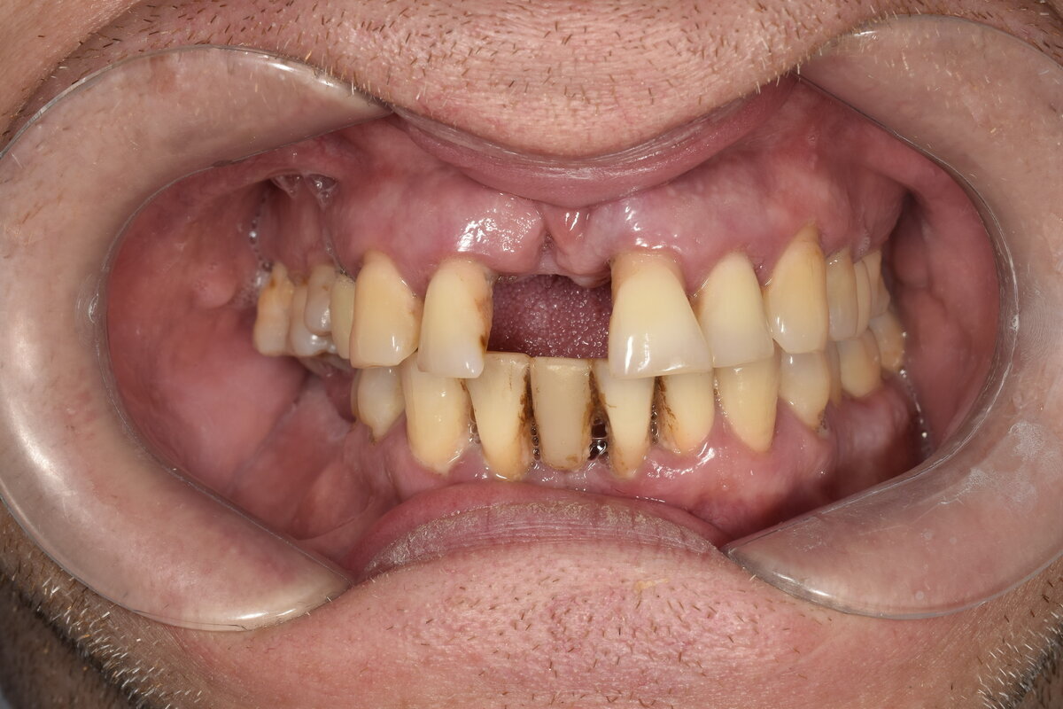 Внутриротовые фото. Как оказывается не хватает не только одного зуба наверху (пациент его достал сам потому что тот уже качался и держался "на ниточке" в десне). Отсутствуют ещё жевательные зубы снизу справа.