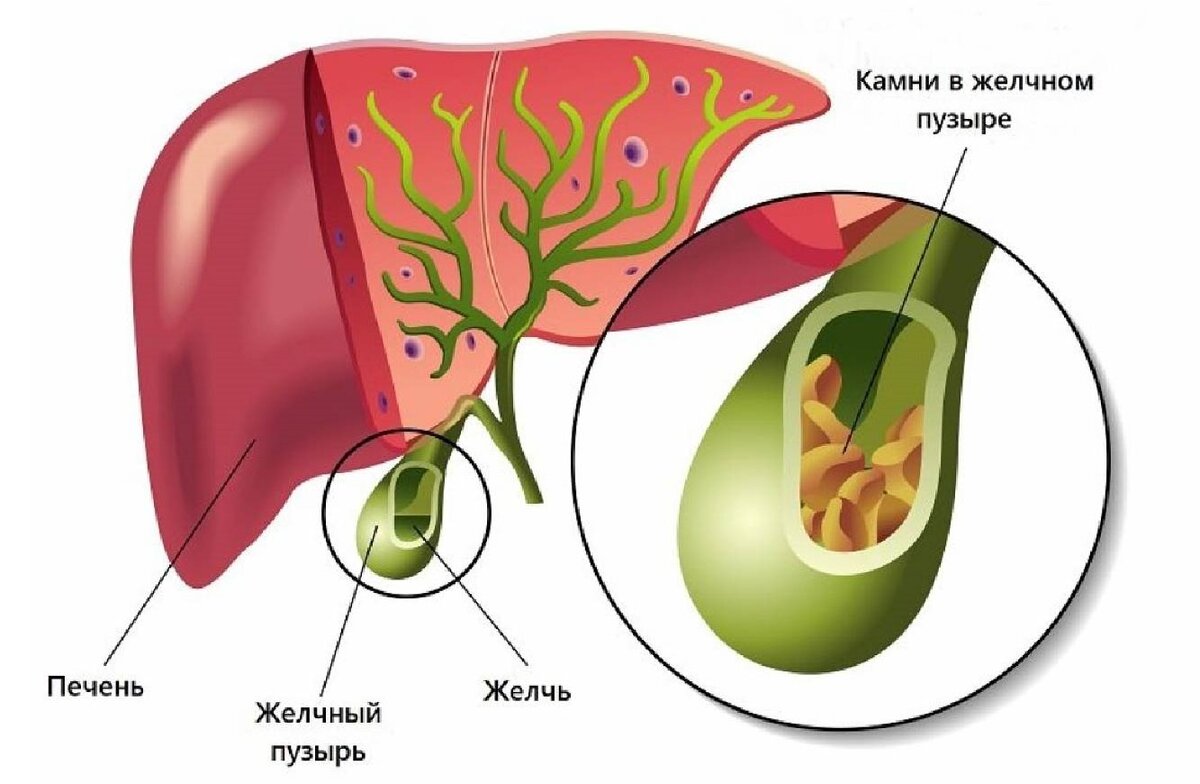 Желчекаменная болезнь это желчь