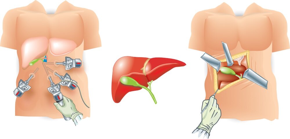 Удаление желчного пузыря лапароскопия диета. Эндоскопия холецистэктомия. Лапаротомная холецистэктомия. Лапароскопическая холецистэктомия показания.