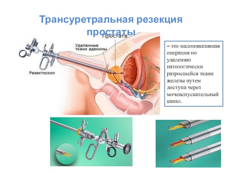 Операция по удалению простаты у мужчин