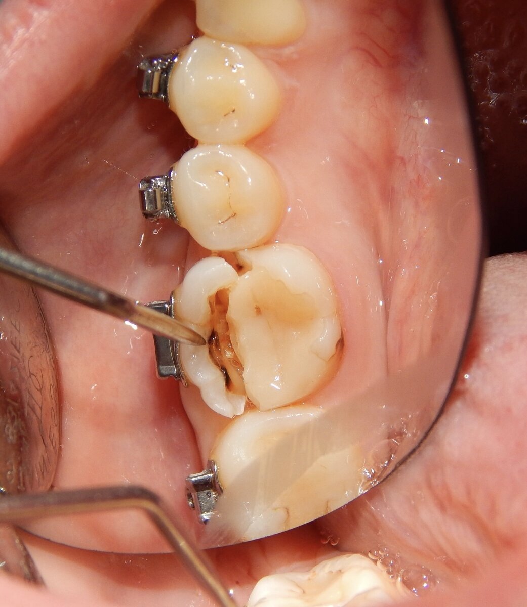 Отрыв стенки зуба брекет-системой