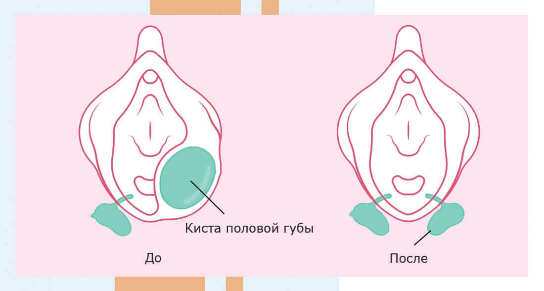 Удаление кисты половой губы