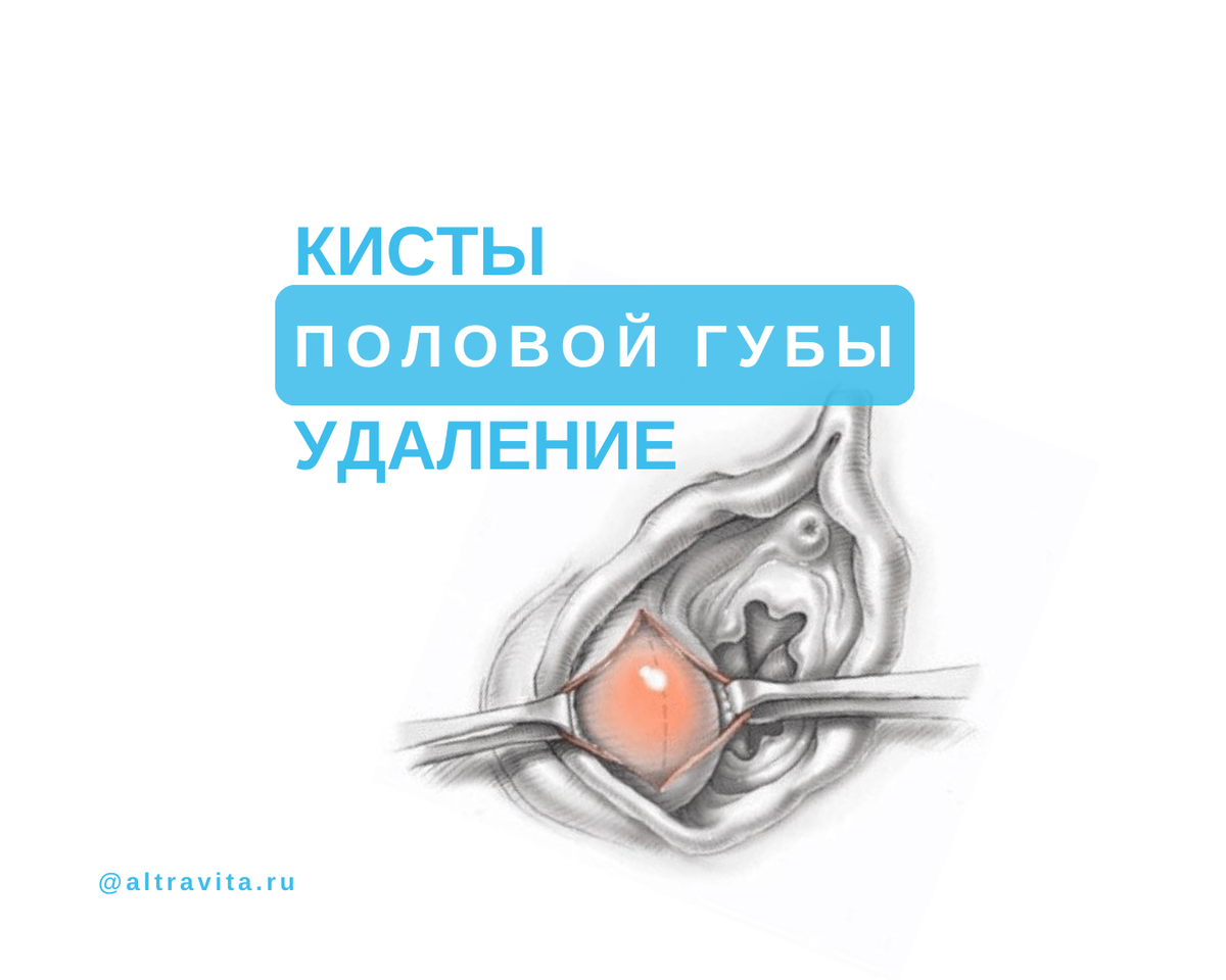 Удаление кист влагалища и наружных половых органов в Казани