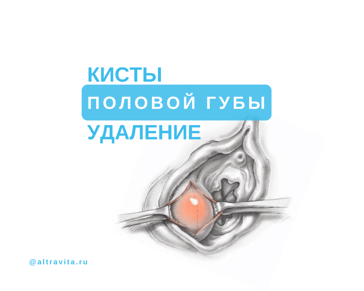 «Можно ли при кисте яичника?»: часто задаваемые вопросы пациенток с кистой