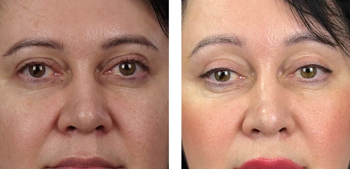 Результат эндоскопической подтяжки лба.