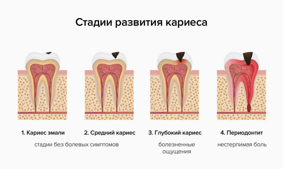 Глубочайший какая степень. Степени развития кариеса. Кариес дентина глубокий кариес. Схема развития кариеса зубов. Симптомы кариеса стадии развития.