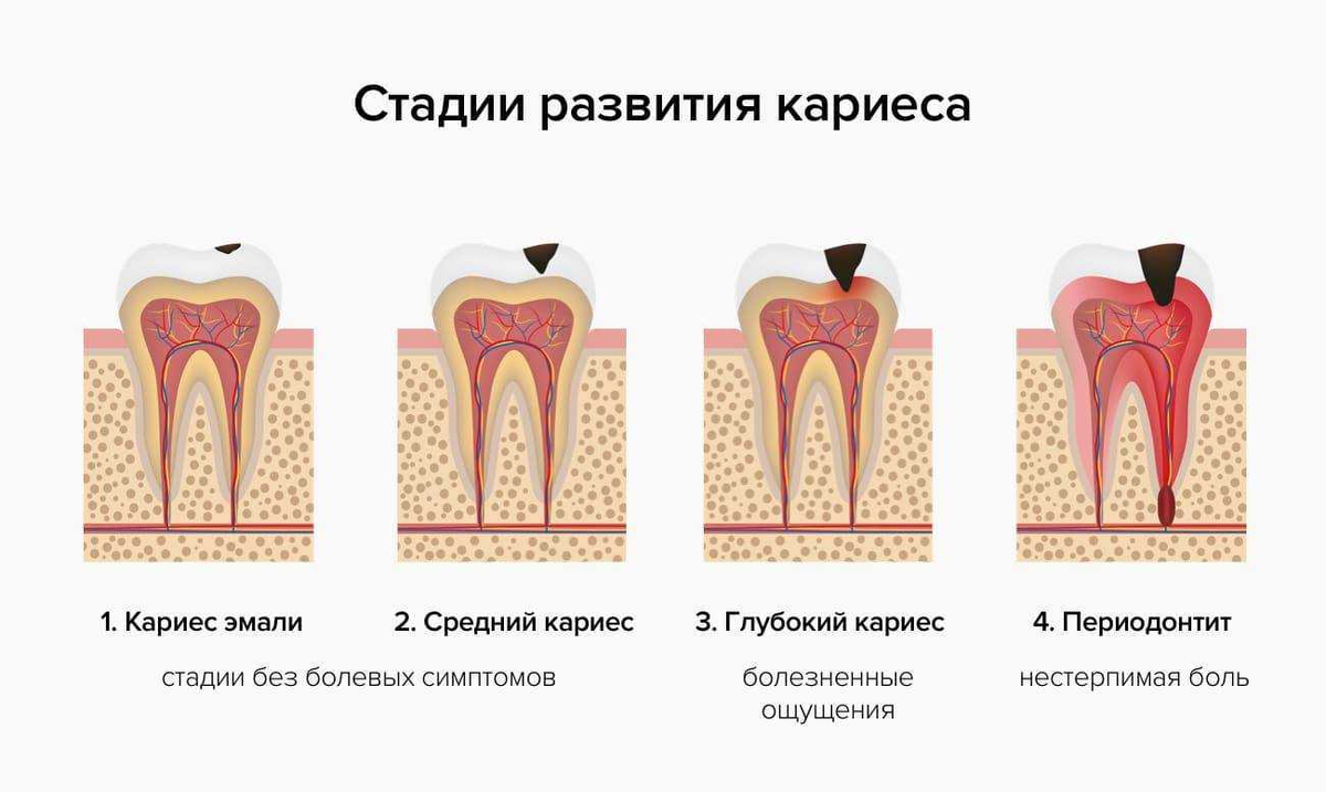 Кариес клиническая картина