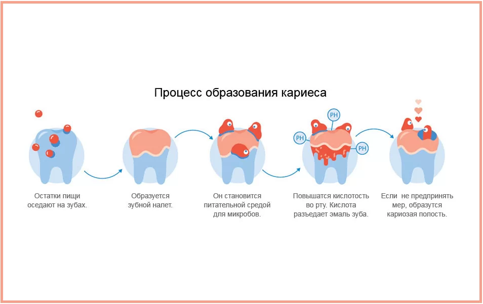 Что способствует кариесу