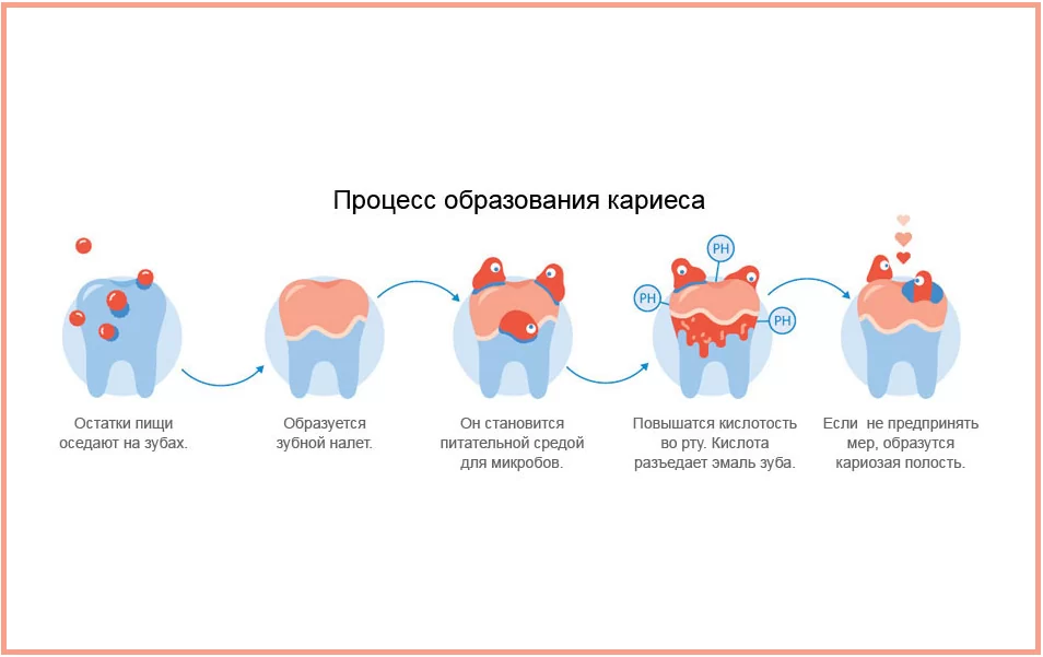 Размер кариеса. Начальный этап развития кариеса. Кариес стадии и процессы. Стадии развития кариеса кариес.