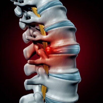 Межпозвоночная грыжа