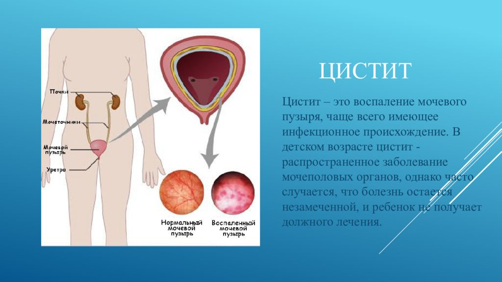 Воспаление пузыря у женщин. Заболевание мочеполовой системы цистит это. Заболевания органов мочевыделения цистит. Презентация на тему цистит. Заболевания мочевого пузыря у детей.