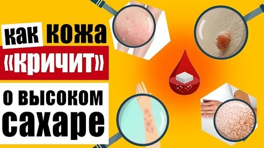 Предупреждающие признаки на коже, которые говорят о высоком уровне сахара в крови