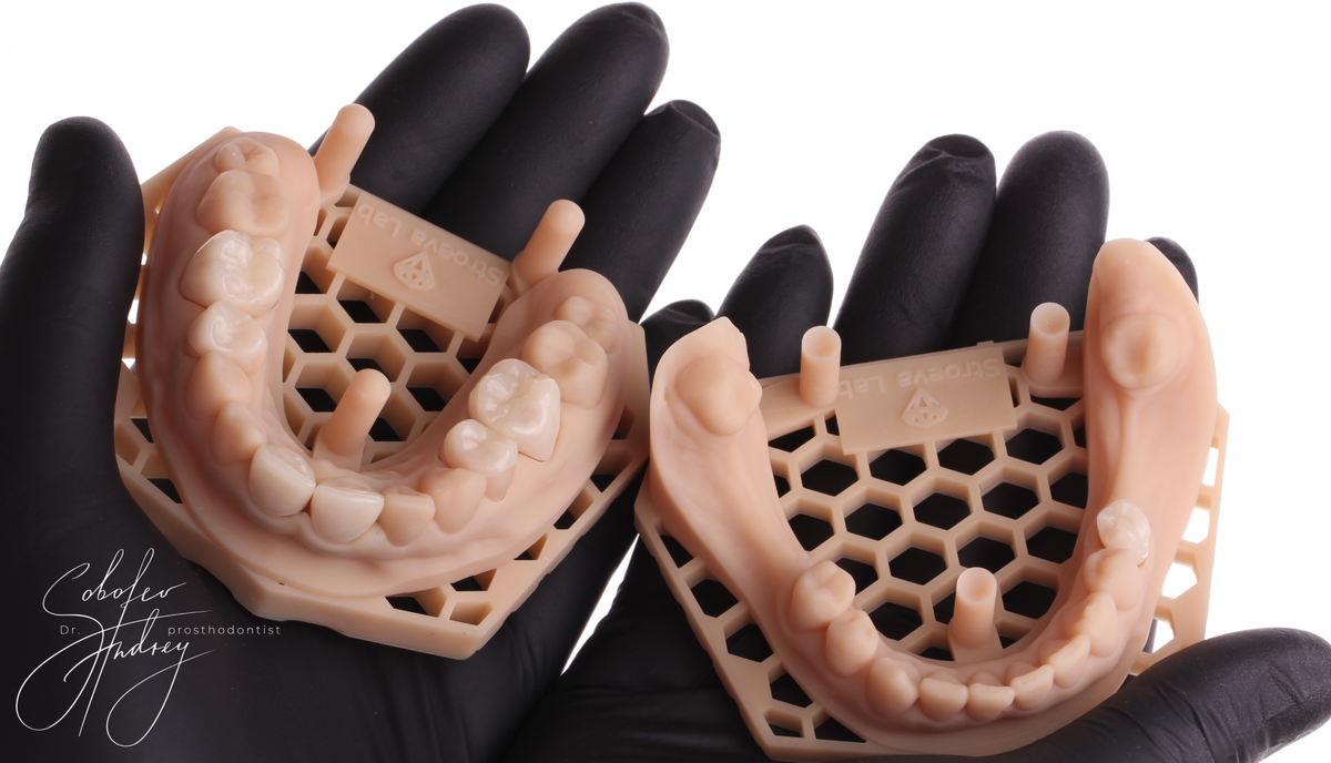 Временные коронки на зубах