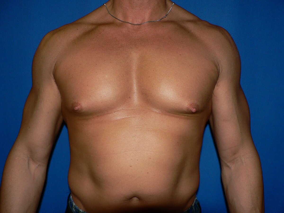 Гинекомастия – когда у мужчины растет грудь | Семейная Бьюти | Дзен